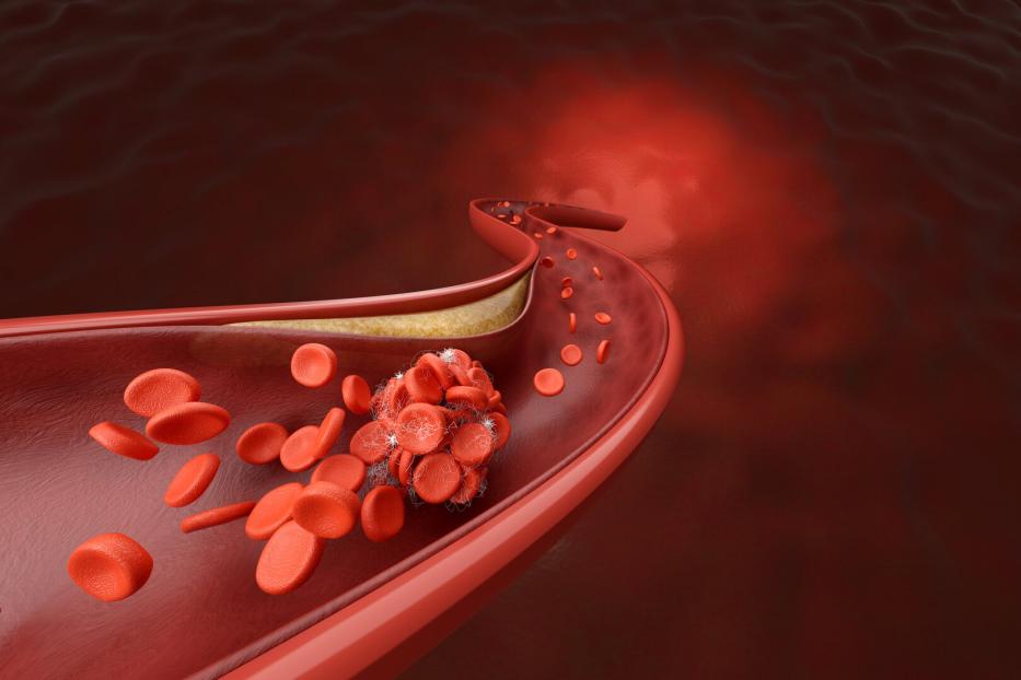 coronary artery and blood clot