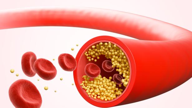 Grafik von Blutzelle und vergrößertes Blutgefäß mit Cholesterin.