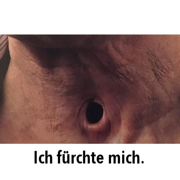 Nahaufnahme eines menschlichen Halses mit einem Tracheostoma.